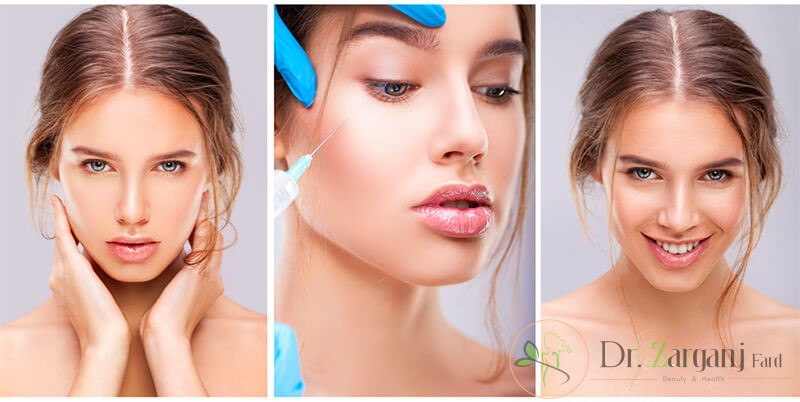از بین بردن خطوط خنده