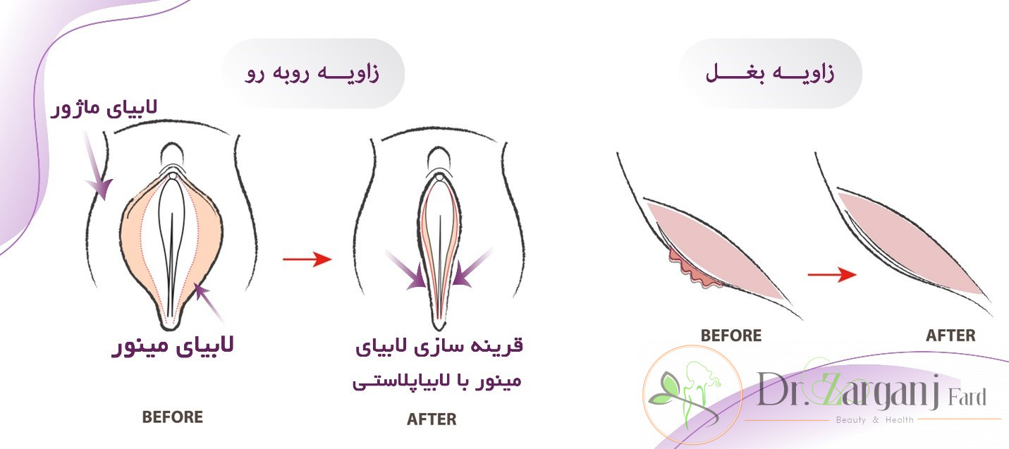 لابیاپلاستی، یک جراحی زیبایی بدون خطر و با ریسک پایین