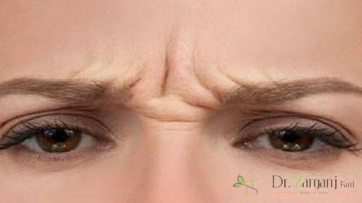 پرداخت هزینه بوتاکس اخم ابرو چه مزایایی را به دنبال خواهد داشت؟
