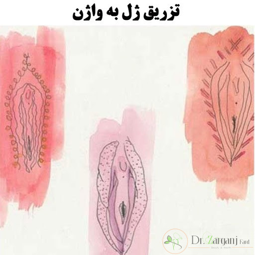 هزینه تزریق ژل به اندام تناسلی زنان