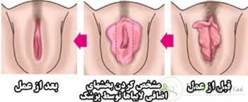به طور خلاصه از توجهات پس از عمل لابیا پلاستی می توان موارد زیر را نام برد: