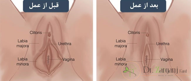 میل جنسی بعد از عمل لابیاپلاستی