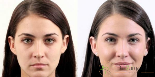 مراقبت های لازم بعد از بوتاکس: