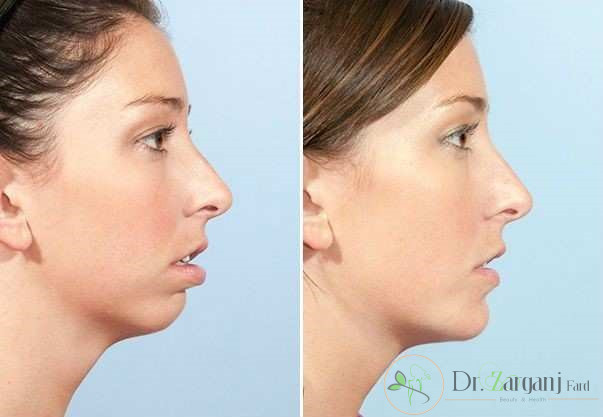 آیا برای تعیین کردن هزینه تزریق ژل به چانه مشاوره لازم است؟