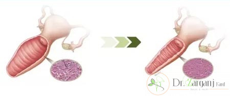 برطرف نمودن و گشادی واژن به واسطه لیزر برای چه کسانی پیشنهاد نمی ‌شود؟