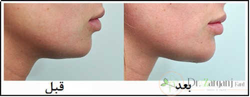 چرا هزینه تزریق ژل به چانه در کلینیک های مختلف با یکدیگر تفاوت دارد؟