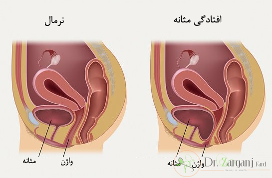 آیا اطلاعاتی درباره روش کار مونالیزا تاچ برای جوان سازی واژن دارید؟