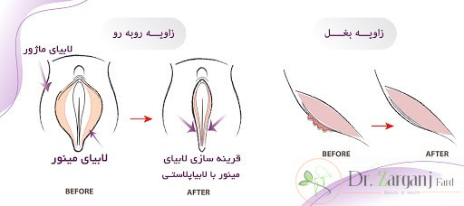بهترین سن برای انجام لابیا پلاستی چه سنی می باشد؟
