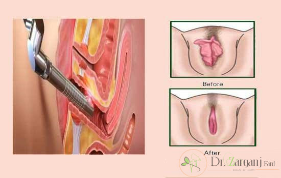 آیا اطلاعاتی درباره آتروفی واژن دارید؟