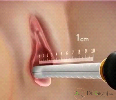 شرایط رنگ پوست فرد و ژنتیک خانوادگی:
