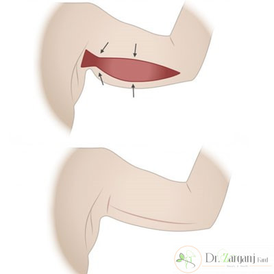 آیا می دانید، نحوه اثر بخشی روش کربوکسی تراپی برای برطرف کردن سلولیت چگونه است؟