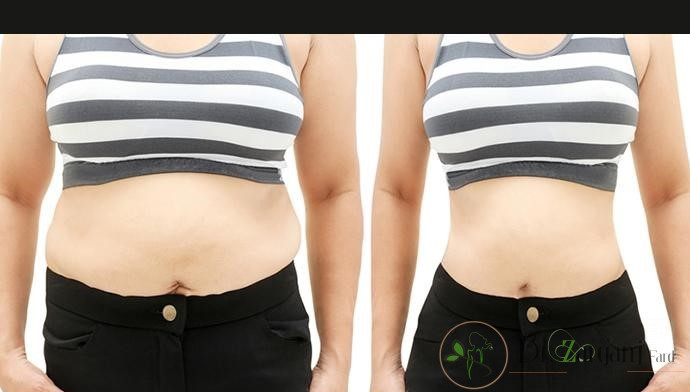 برای درمان سلولیت با استفاده از کربوکسی تراپی به چه تعداد جلسه درمانی نیاز است؟