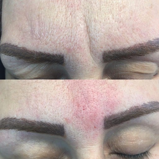 تاثیرات منفی سیگار بر روی نتیجه تزریق