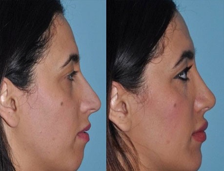 آیا می دانید جراح تزریق چربی به فک را چگونه انجام می دهد؟