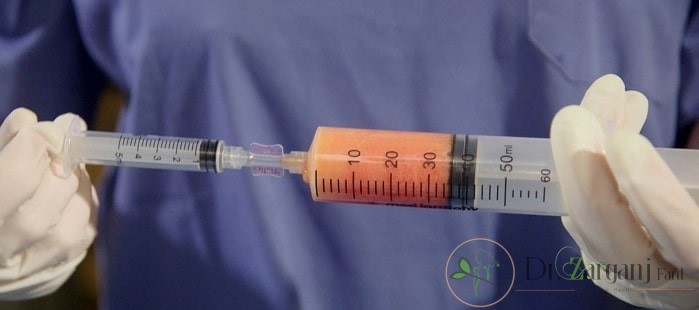 چه کسانی می توانند از روش تزریق چربی به باسن استفاده نمایند؟