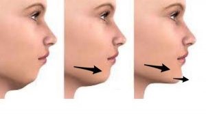 تزریق چربی با دیگر روش های حجیم سازی چه فرقی دارد؟
