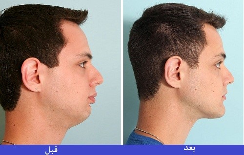 قبل از تزریق چربی باید چه مواردی را مورد توجه قرار بدهیم؟