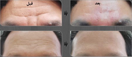 قبل از تزریق چربی برای برطرف کردن خط اخم به چه نکاتی باید توجه کرد؟