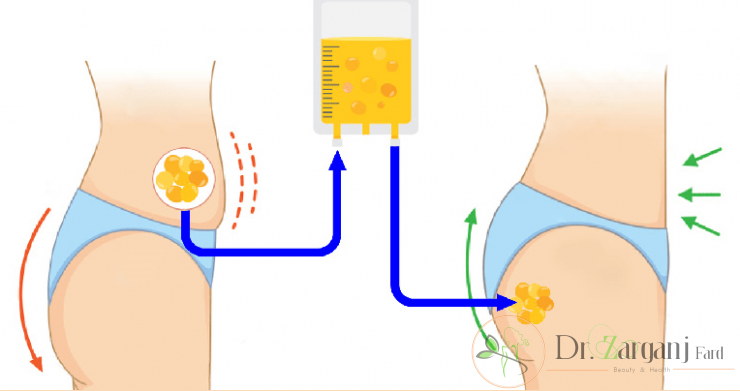 هزینه تزریق چربی به باسن