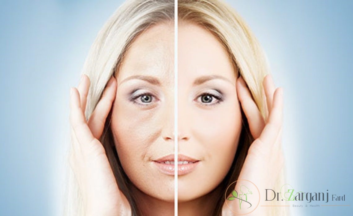 چین و چروک های ناحیه زیر چشم