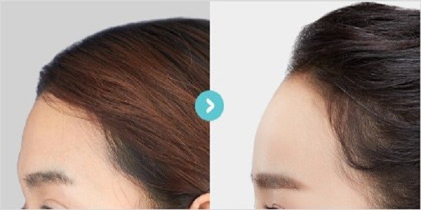 یکی از روش های موثر برای جوانسازی صورت