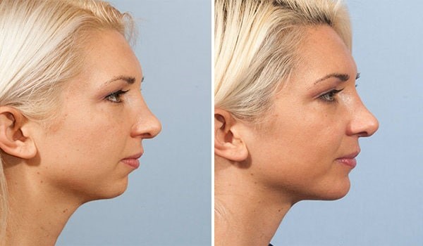 microfat grafting