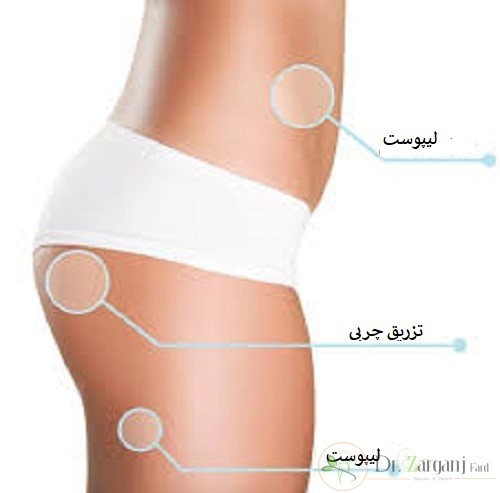 آیا اطلاعاتی در رابطه با تزریق چربی به باسن دارید؟