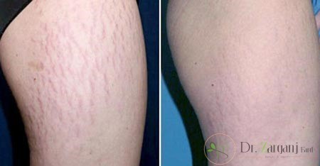 تشخیص ترک های پوستی چگونه صورت میگیرد؟
