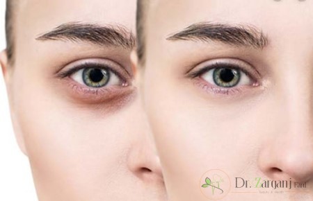بعد از تزریق چربی برای رفع گودی زیر چشم چه نکاتی را باید رعایت کرد؟
