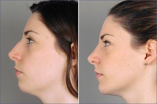 تزریق چربی چگونه روشی است؟
