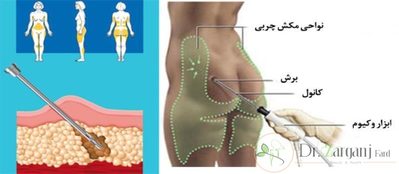 با کمک تزریق چربی باسن افراد حجیم میشود