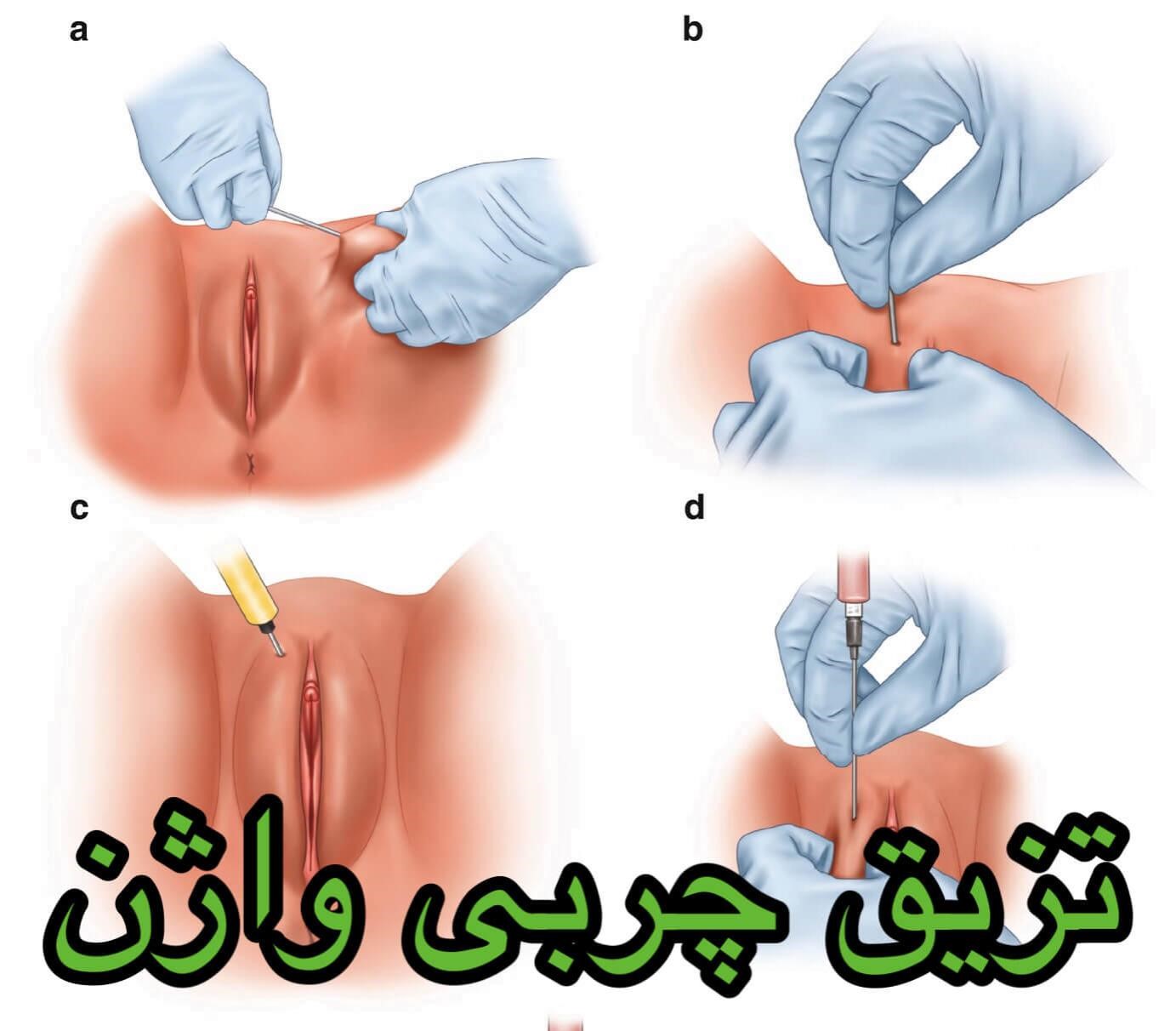 تزریق چربی به ناحیه واژن