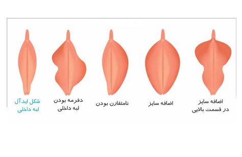 علل بزرگ شدن لابیا