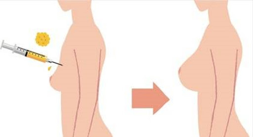 تزريق چربي به سينه در اهواز