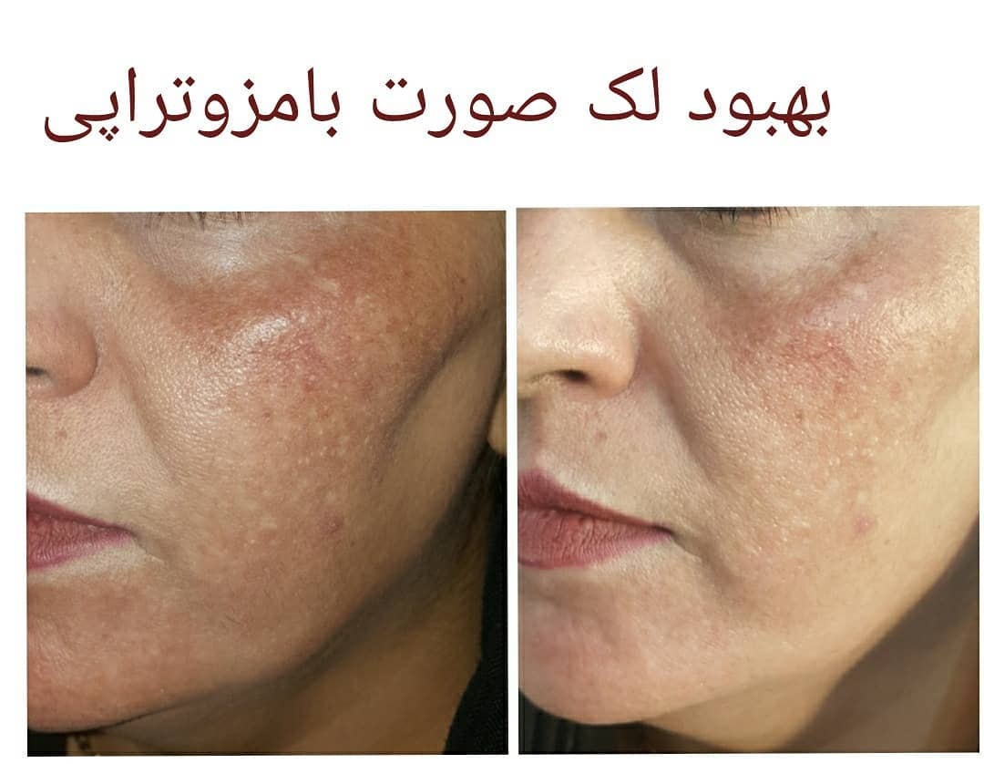 مزایای جلسات مزوتراپی لک صورت