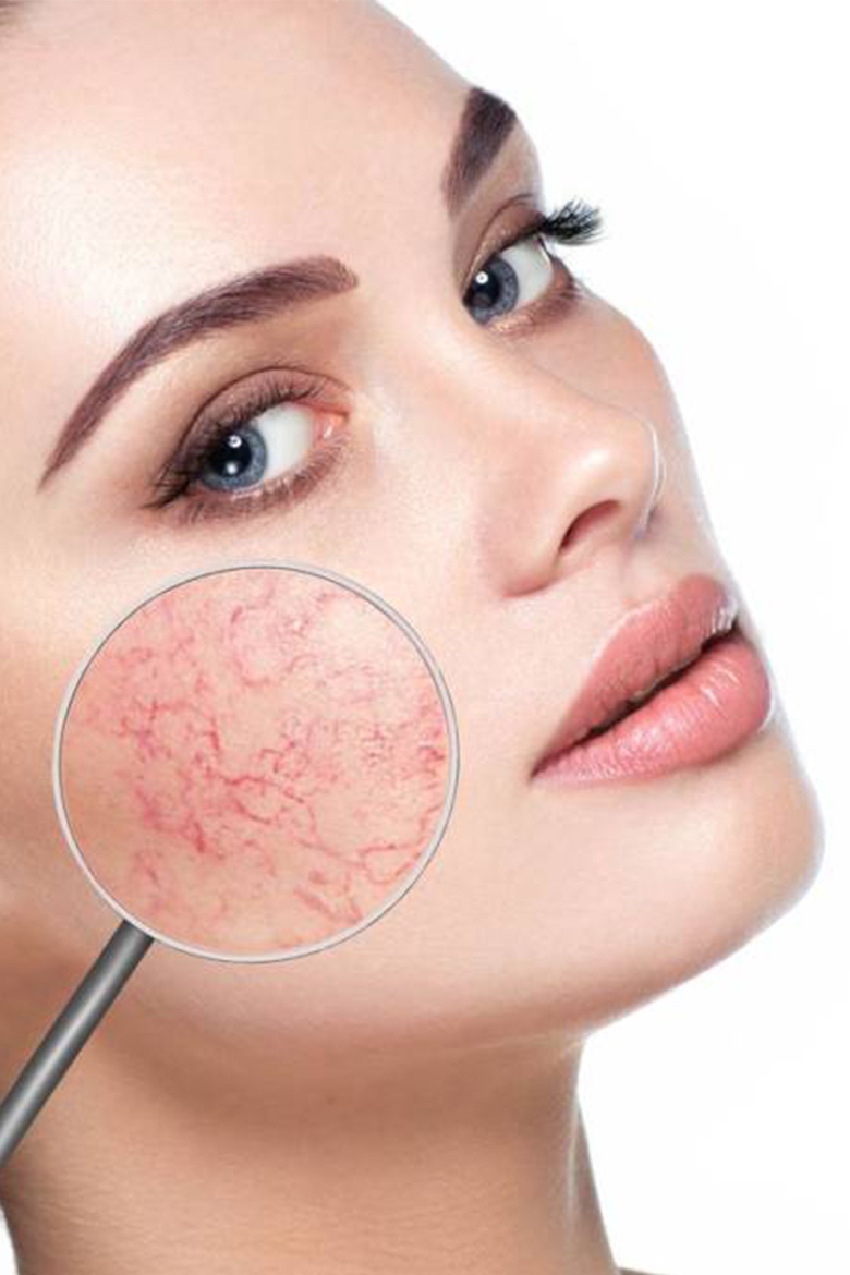 مزوتراپی مجاز به استفاده برای کودکان نیست