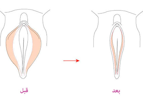 منظور از عمل زیبایی واژن حین زایمان چه می باشد؟