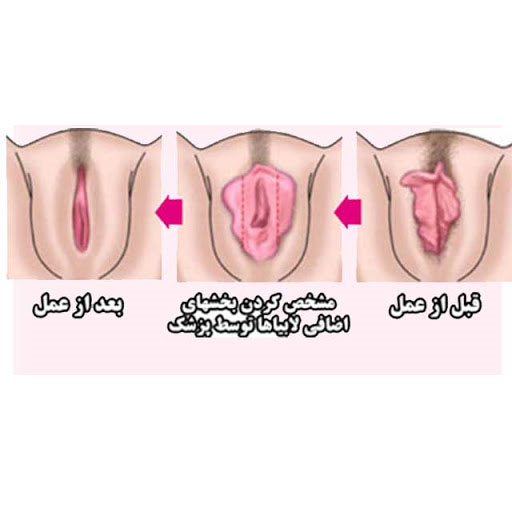 عمل لابیاماژوپلاستی