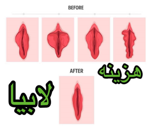 هزینه ی لابیاپلاستی حدودا چقدر است؟
