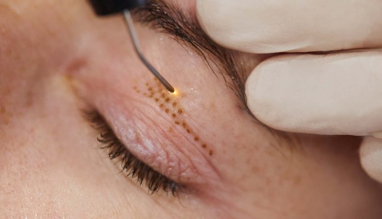 کدامیک از روش های بر طرف کردن پلک با جراحی یا لیزر موثر واقع می شود؟