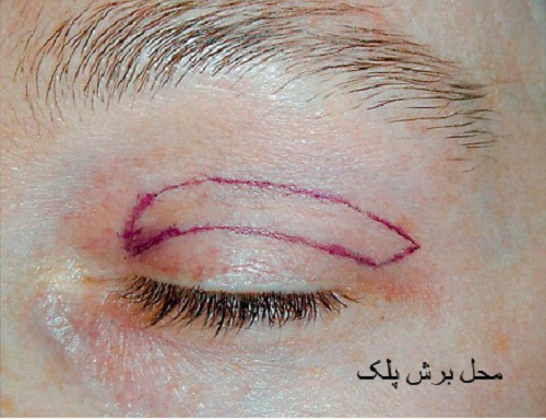 حال به طور کلی شرایط کاندیدای برداشتن پف بالای چشم عبارتند از: