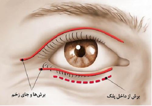 یک برش کوچک در بخش پایینی پلک به واسطه لیزر co2