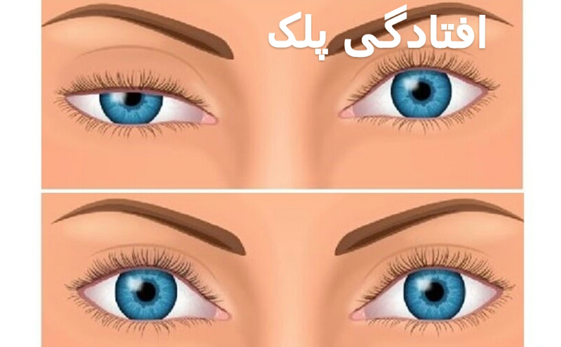 اثر روش پلاسما جت پلک تا چه مدت ماندگاری و دوام دارد؟
