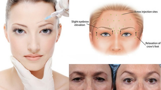 شیوه تزریق ژل خط اخم توسط پزشک متخصص