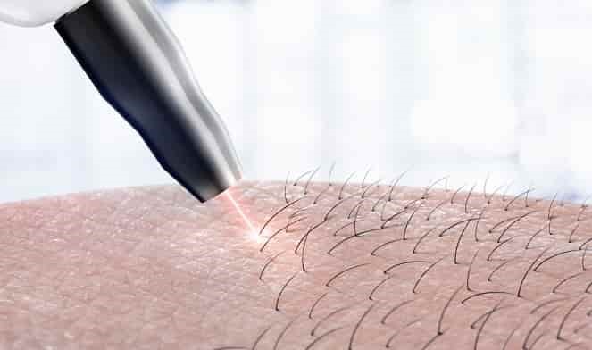 آیا بعد از اقدام به لیزر بیکینی می توانیم آن ناحیه را اصلاح نماییم؟