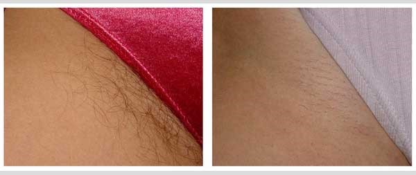 آیا متوقف شدن رشد موهای زائد در شیوه ی لیزر بیکینی برای همیشه و به صورتی دائمی خواهد بود؟