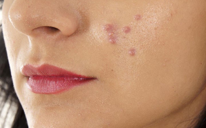 از دیگر نمونه ها و تاثیرات لیزر فراکشنال می توانیم موارد ذیل را نام ببریم: