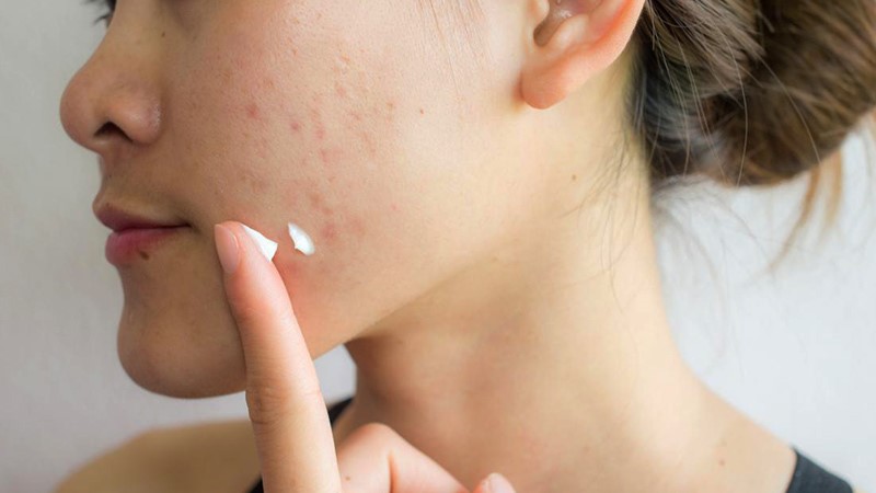 برای بعد از اجرای لیزر فراکشنال، پزشک متخصص چه داروهایی را مورد تجویز قرار می دهد.