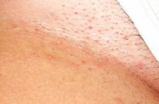 بیشترین تاثیر لیزر بیکینی بر روی چه سبک موهایی می باشد؟