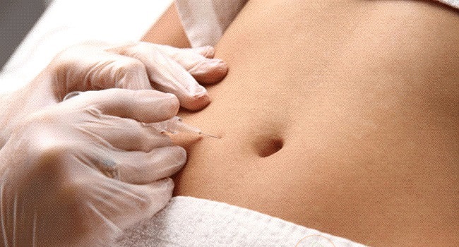 مقایسه لیپولیز و CoolSculpting